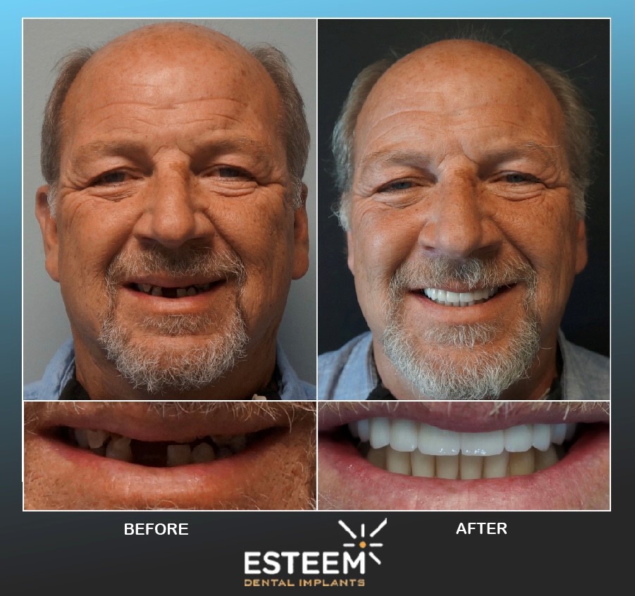 Esteem Implants Before and After