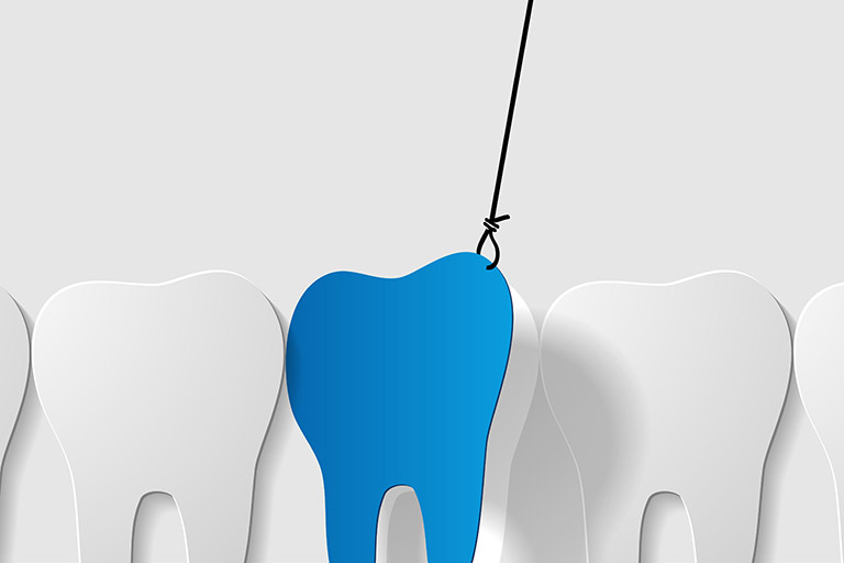 Tooth Extractions in Cape Coral, FL