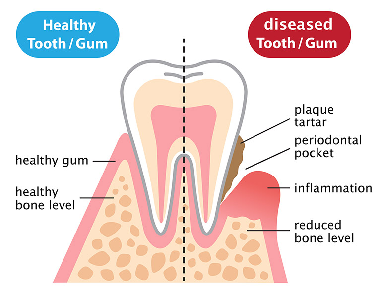 Healthy vs Diseased gum