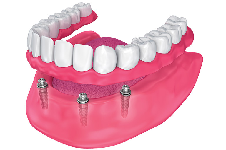 Snap On Denture in Cape Coral Florida