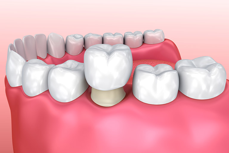 Metal Free Crowns in Cape Coral, FL